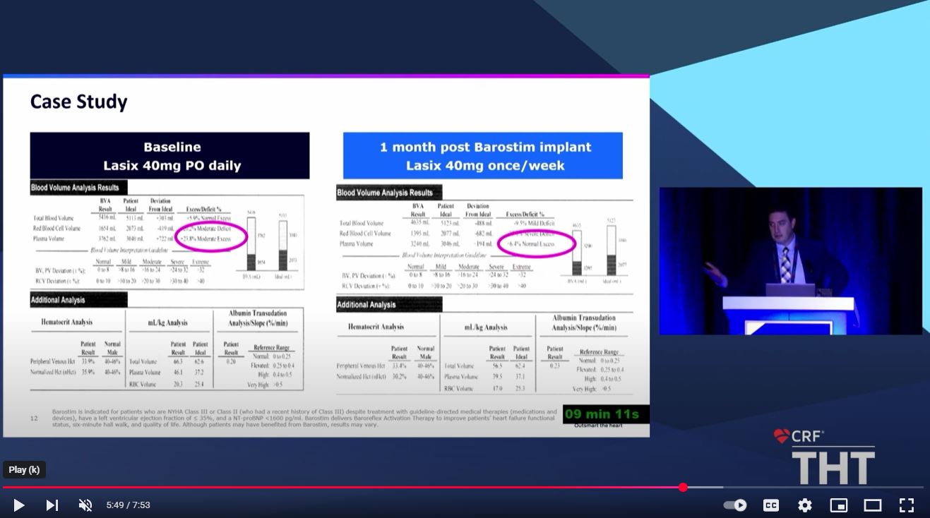 Real-world Results with Barostim within a Multi-disciplinary HF Program by Dr. Patrick McCann (THT 2025)